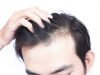Tout savoir sur la greffe de cheveux