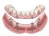Implants dentaires All-on 4, coût de la procédure