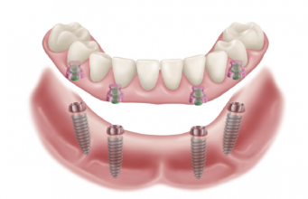Implants dentaires All-on 4, coût de la procédure